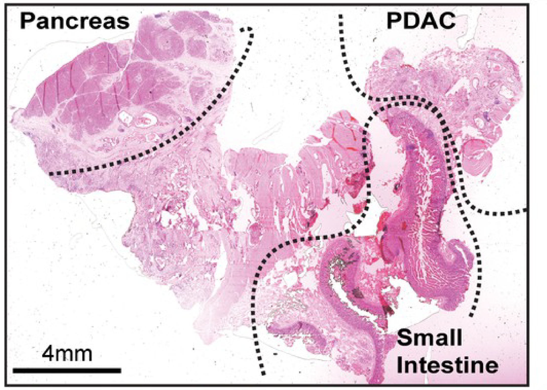 H&E staining of pancreatic ductal adenocarcinoma (PDAC) resection specimen that includes portions of cancer and non-malignant pancreatic tissue and small intestine.