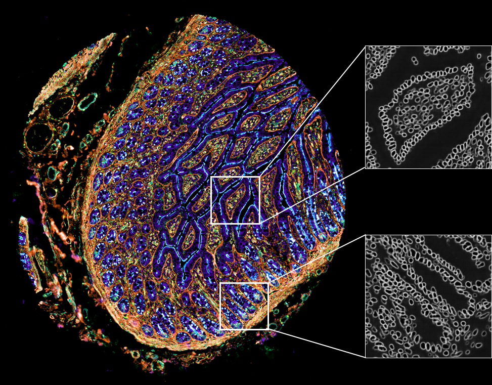 Image of a single TMA core with two insets that show single cells that have been segmented